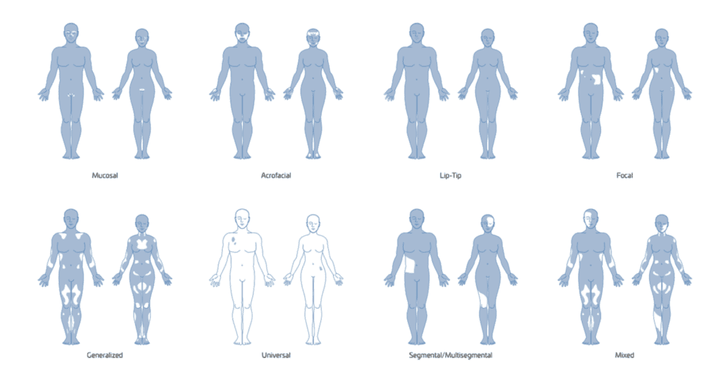 Vitiligo Diagram